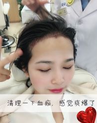 -大麦微针植发全国连锁