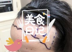 -大麦微针植发全国连锁