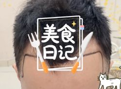 -大麦微针植发全国连锁