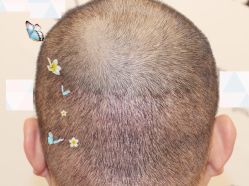 -大麦微针植发全国连锁