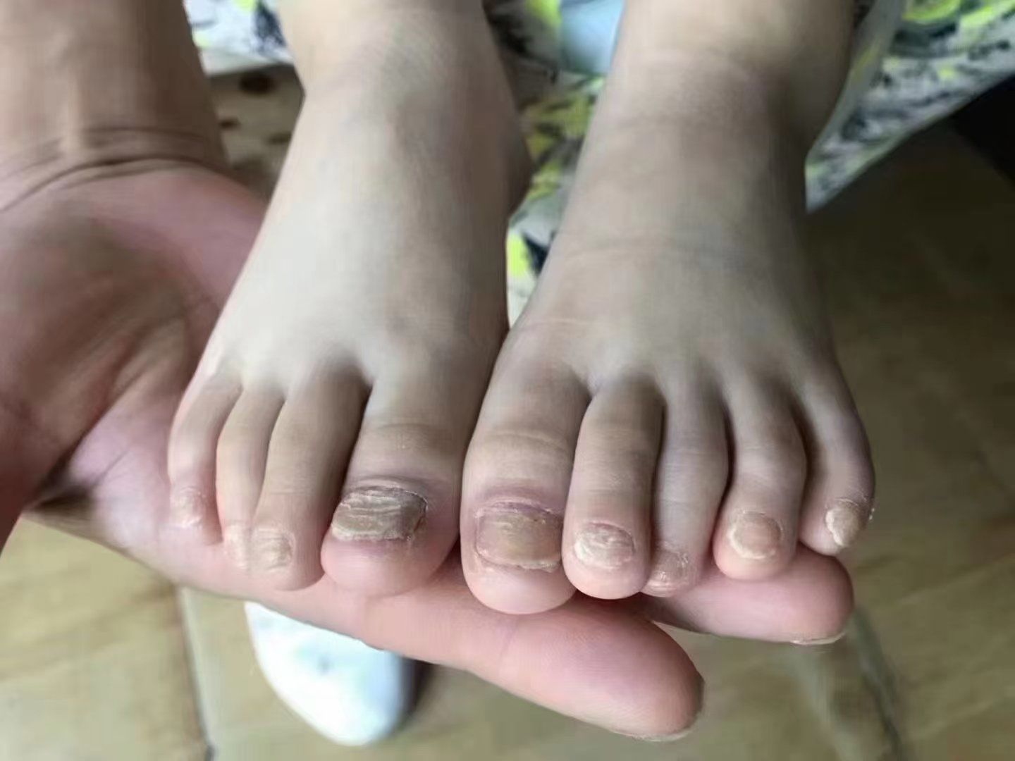 手足甲健康知识科普分享
💚 灰二代💚 "灰指甲"
家里