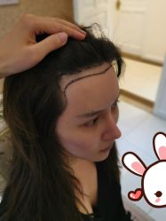 点击看大图 -大麦微针植发丨全国连锁