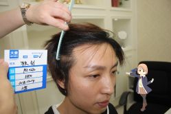 -大麦微针植发丨全国连锁