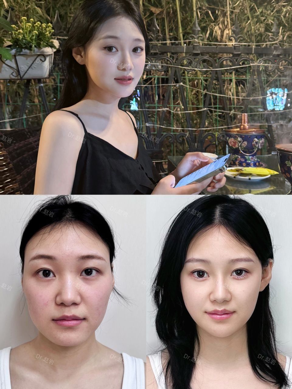 打造自然幼态脸,到底需要多少支玻尿酸?