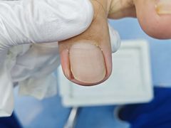 -Andrew指甲专科灰指甲·甲沟炎矫正·3D步态矫形鞋垫定制(浦三路店)