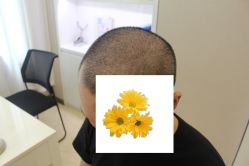 -大麦微针植发丨全国连锁