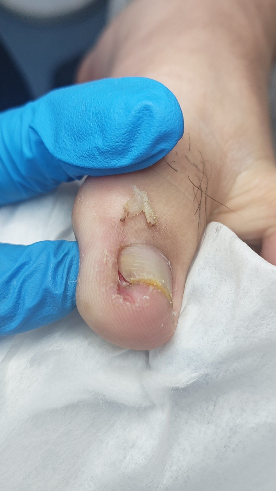 疼痛甲沟炎一南京老崔专业治疗