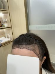 -碧莲盛·不剃发植发