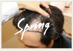 点击看大图 -大麦微针植发全国连锁