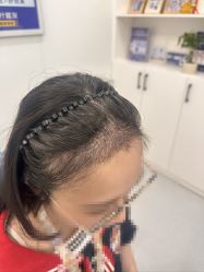 -大麦微针植发全国连锁