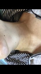-美丽人生祛斑扁平疣汗管瘤中心