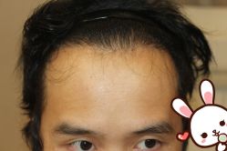 -大麦微针植发丨全国连锁