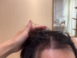 -碧莲盛·不剃发植发