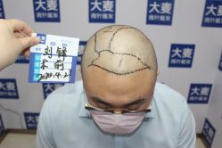 -大麦微针植发丨全国连锁