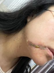 -美丽人生祛斑扁平疣汗管瘤中心