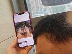 -碧莲盛·不剃发植发