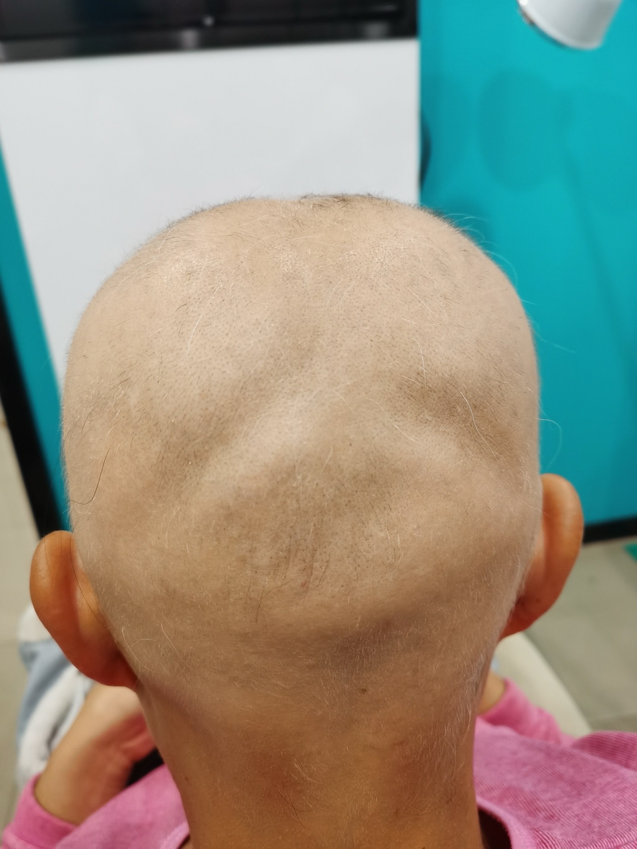 斑秃的第二形态全秃,恢复如初