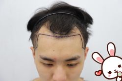 点击看大图 -大麦微针植发丨全国连锁