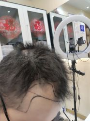 -碧莲盛·不剃发植发