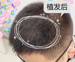 -大麦微针植发全国连锁