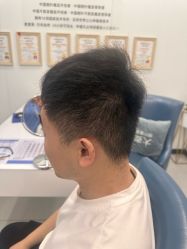 -大麦微针植发全国连锁
