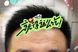 -大麦微针植发全国连锁