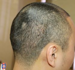 -大麦微针植发丨全国连锁