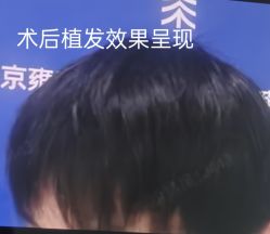 -北京雍禾植发医院