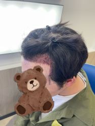 -大麦微针植发全国连锁