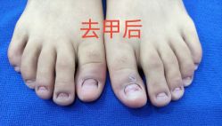 -德哥灰指甲脚气甲沟炎跖疣护理