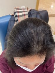 体验后-大麦微针植发丨全国连锁