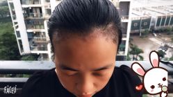 -大麦微针植发丨全国连锁