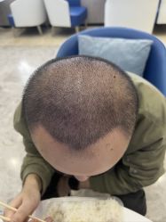 -大麦微针植发全国连锁