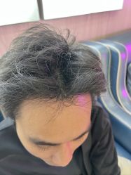 -大麦微针植发全国连锁
