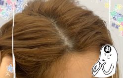 -大麦微针植发全国连锁