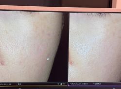 -苑苑vbeauty科技美容SPA