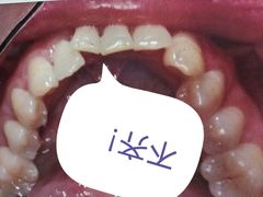 -上海仁爱医院口腔科 · 种植