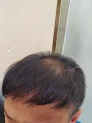 -碧莲盛·不剃发植发