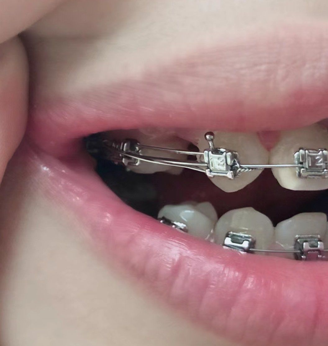 以前觉得牙齿不齐,门牙往外突,就犹豫很久