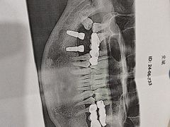-上海仁爱医院口腔科 · 种植