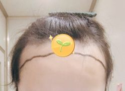 -大麦微针植发全国连锁
