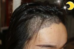 -大麦微针植发丨全国连锁