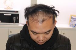 点击看大图 -大麦微针植发丨全国连锁