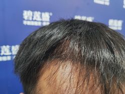 -碧莲盛·不剃发植发