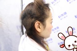 -大麦微针植发丨全国连锁