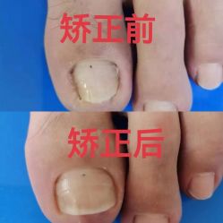 -德哥灰指甲脚气甲沟炎跖疣护理