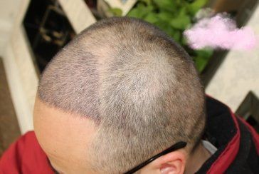 -大麦微针植发丨全国连锁