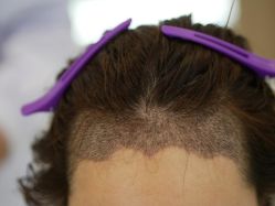 -大麦微针植发丨全国连锁