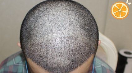 -大麦微针植发丨全国连锁