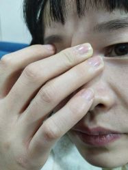 -北京美痣堂古方祛痣斑疣瘊